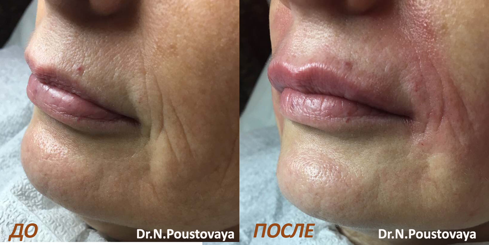 Увеличение губ Dermafill Lips, Луганск, Монро-Мед, фото до и после